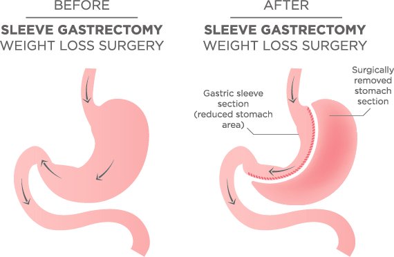 best gastric sleeve surgeon